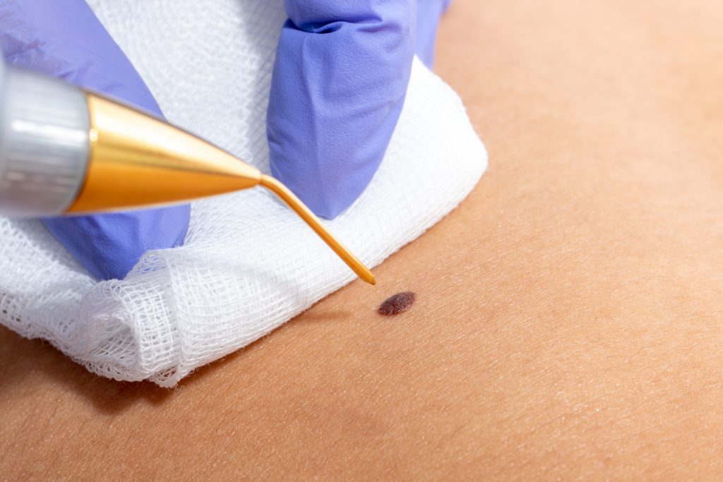 Cosmetic Mole Removal Skin Deep Cosmetic Clinic